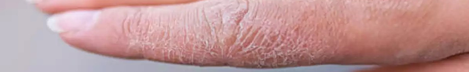 Kako se lahko suhi koži na rokah izognemo?